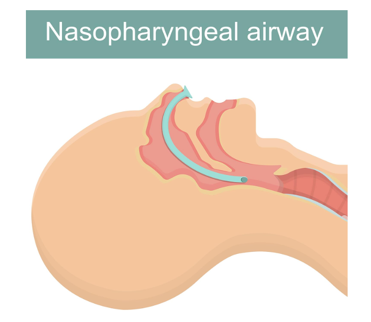 28 French (7mm) Nasal Pharyngeal tube